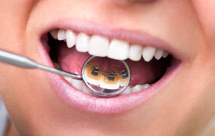 img-Braces Behind Your Teeth 
